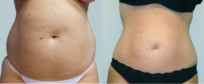 25-34 year old woman treated with Aqualipo on abdomen - Aqualipo liposuction on her abdomen&nbsp;gave this 32-year old female back her hourglass figure. We personalize each liposuction to the patient's individual needs and typically use a combination of Body Jet water liposuction and SmartLipo laser liposuction to achieve optimal fat removal and skin tightening.