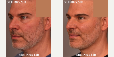 Man treated with Mini Neck Lift - Man treated with Mini Neck Lift