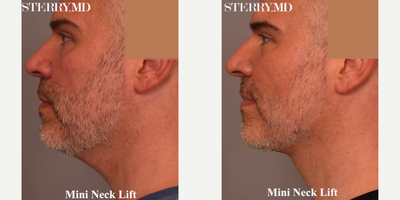 Man treated with Mini Neck Lift - Man treated with Mini Neck Lift