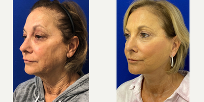 66 year old woman treated with Facelift - 66 year old woman treated with Facelift and TCA Peel