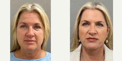 51 year old woman treated with Facelift, Neck Lift, Lower Facelift - 51 yo s/p facelift/ neck lift performed under local anesthesia with sedation in our on site AAAA certified operating suite.