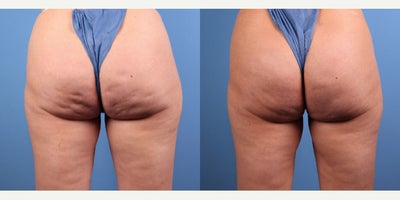 47 year old woman treated with Aveli - Improvement in cellulite after Aveli treatment.
