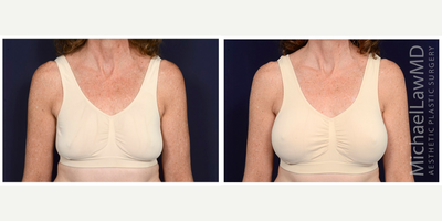 55-64 year old woman treated with Mentor Breast Implants - Breast augmentation. Follow-up photos taken 1 month after the procedure.