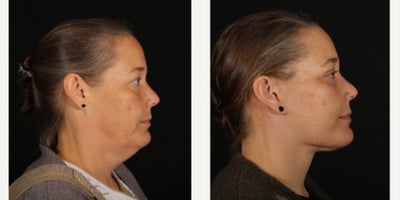45-54 year old woman treated with Facelift, Neck Lift, Deep Plane Facelift, Eyelid Surgery, Facial Fat Transfer, Double Eyelid S - We had our third & final visit with one of our favorite #kansascity patients after her facelift, deep neck lift, upper and lower #blepharoplasty and fat grafting. I really spent a lot of time trying to get the neck contour correct and I think she's healing beautifully. She's also got an awesome attitude and our team loves her. Thanks to her for letting us share her #facelift journey!