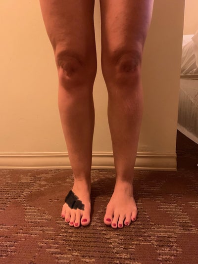 Calf and Ankle Liposuction