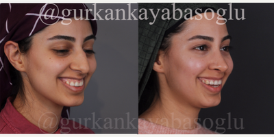 18-24 year old woman treated with Lip Repositioning, Rhinoplasty - 18-24 year old woman treated with Lip Repositioning, Rhinoplasty