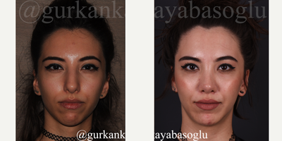 25-34 year old woman treated with Lip Repositioning - 25-34 year old woman treated with Lip Repositioning