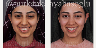 18-24 year old woman treated with Lip Repositioning, Rhinoplasty - 18-24 year old woman treated with Lip Repositioning, Rhinoplasty