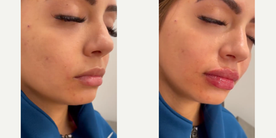 Woman treated with Juvederm - Woman treated with 1ml of Juvederm XC as lip fillers