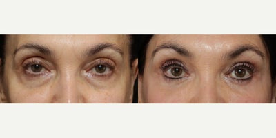 Woman treated with Eyelid Surgery - Woman treated with Eyelid Surgery