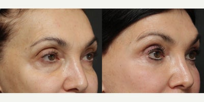 Woman treated with Eyelid Surgery - Woman treated with Eyelid Surgery