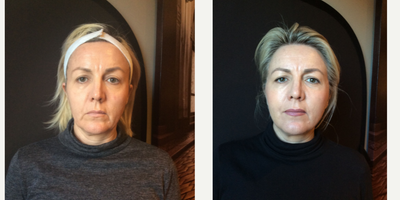 45-54 year old woman treated with Non Surgical Face Lift- Thread Lift - Advanced, customized Thread Lift. No dermal filler or other volume treatment was used, only PDO barbed threads.