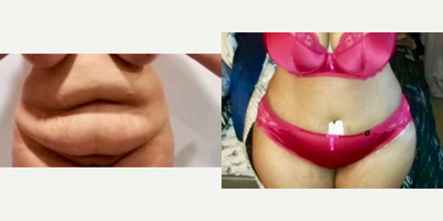 35-44 year old woman treated with Tummy Tuck, Liposuction, Brazilian Butt Lift - Excellent outcome after full tummy tuck combined with intense liposuction including abdomen, waist, laterals and upper and lower back to improve your body contour and get better curves, especially in your waist area and dominican butt lift.