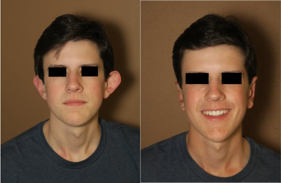 17 or under year old man treated with Ear Surgery - otoplasty