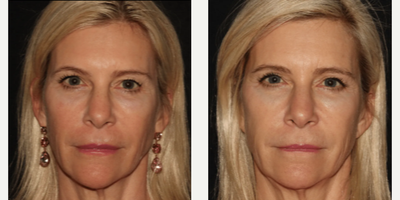 Woman treated with Emface - Emface