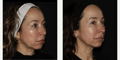 Woman treated with Emface - Emface