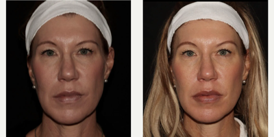 Woman treated with Emface - Emface