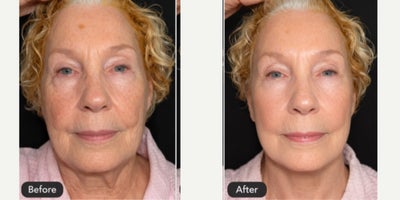 65-74 year old woman treated with Nonsurgical Facelift - MIPPS Face (Minimally Invasive Precision Plication Suspension Facelift)What is MIPPS Face?MIPPS Face is an advanced minimally invasive facelift technique designed to restore a more youthful, refreshed appearance with significantly less downtime than a traditional facelift. The procedure focuses on lifting and repositioning facial tissues through small, strategically placed incisions while minimizing tissue disruption.Unlike procedures that simply tighten the skin, MIPPS Face addresses the underlying facial structures responsible for sagging, jowls, loss of jawline definition, and facial aging. By elevating and securing deeper support tissues, the procedure creates natural-looking rejuvenation while preserving each patient's unique facial characteristics.Benefits of MIPPS FaceMinimally invasive approachSmaller incisionsReduced recovery timeImproved jawline definitionReduction of jowls and facial saggingMore youthful facial contoursNatural-looking resultsCan be performed under local anesthesia in many casesLess bruising and swelling compared to traditional facelift techniquesIdeal CandidatesMIPPS Face may be appropriate for men and women experiencing:Mild to moderate facial saggingEarly jowl formationLoss of jawline definitionNeck laxityFacial volume descent associated with agingDesire for facial rejuvenation without undergoing a more extensive traditional faceliftRecoveryMost patients experience temporary swelling and bruising that gradually improves over the first few weeks. Because MIPPS Face utilizes a minimally invasive approach, many patients return to social activities sooner than they would following a conventional facelift procedure.ResultsPatients often notice an immediate improvement in facial contour and definition, with continued refinement as swelling subsides. Results are designed to appear refreshed and natural rather than overly tight or artificial.Important NoteEvery patient ages differently, and candidacy for MIPPS Face is determined during a personal consultation. The procedure is customized to each individual's facial anatomy, skin quality, and aesthetic goals to achieve the most natural and balanced outcome possible.MIPPS Face is designed to help patients look younger, more rested, and more confident while minimizing downtime and maintaining a natural appearance.