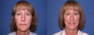 Injectable Fillers - 
	Injectable Fillers
