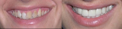 Lumineers - 
	Patient was unhappy with her smile she had crowding and discoloration. Lumineers were placed on her upper anterior teeth to give her the bright perfect smile she always wanted.
