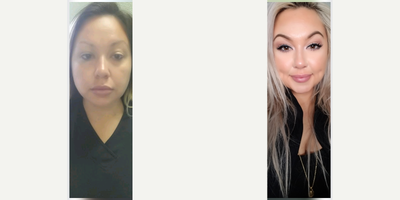 25-34 year old woman treated with Timeless Dimpleplasty - 25-34 year old woman treated with Timeless Dimpleplasty