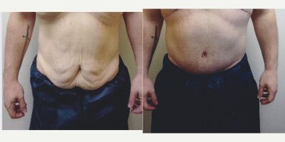 35-44 year old man treated with Body Lift - Weight-loss patient; Circumferential Body lift
