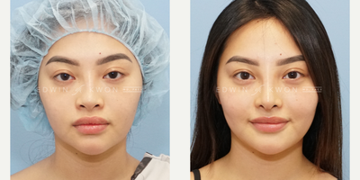 18-24 year old woman treated with Asian Rhinoplasty, DCF Rhinoplasty (2 Wk Update) - 18-24-year-old woman treated with DCF rhinoplasty. Patient had been utilizing filler to her nose for several years. Patient was seeking to have a more permanent change. Preoperative photos still show filler in her nose which was removed intraoperatively with a combination of direct removal as well as hyaluronidase. Her nasal bridge had become much flatter and thus needed reestablishment of height with a DCF graft. The nasal tip was refined with a combination of soft tissue debulking, cephalic trim, and increased tip projection. A nasal cap graft created from the ear cartilage was placed on the tip to soften the tip appearance as the patient wanted to have a more button nose tip. Patient had significant asymmetry in the nasal side walls, thus requiring unilateral osteotomy.