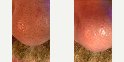 Man treated with HydraFacial - Man treated with HydraFacial