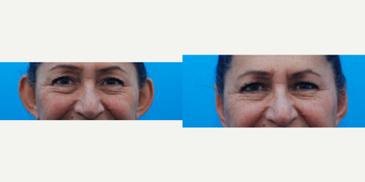 55-64 year old woman treated with Otoplasty or Earfold or Ear Pinning Surgery - 60 yo F after ear pinning surgery