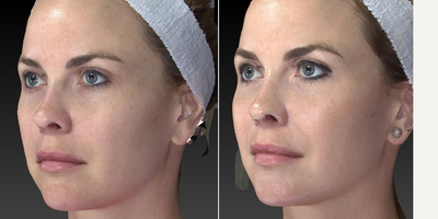 25-34 year old woman treated with Facial Fat Transfer - This is a pretty young woman who only need a small change. We did a fat transfer and lower blepharoplasty with fat repositioning.