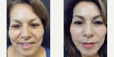 Woman treated with Mini Facelift - Woman treated with Mini Facelift