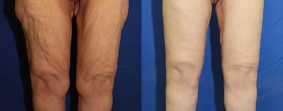 45-54 year old woman treated with Thread Lift - This patient was unhappy with the excess skin of her thighs after massive weight loss. The doctor performed a medial thigh lift to remove the excess skin of her inner thighs.