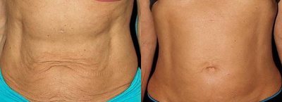 45-54 year old woman treated with Thermage - 3 months after Thermage abdomen