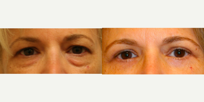 Female Concerned with Tired appearing eyes - Upper and Lower Blepharoplasty with Fat Transfer