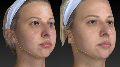 25-34 year old woman treated with Restylane Lyft - CoolSculpting Procedure to reduce fat and sculpt this young woman's arms.