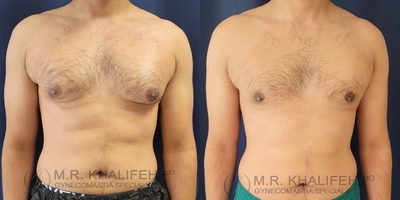 Man treated with Gynecomastia Surgery - Man treated with Gynecomastia Surgery