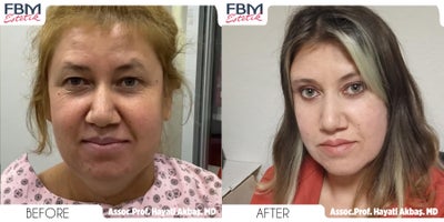 35-44 year old woman treated with Mini Facelift, Eyelid Surgery, Buccal Fat Removal, Facial Fat Transfer - 35-44 year old woman treated with Mini Facelift, Eyelid Surgery, Buccal Fat Removal, Facial Fat Transfer