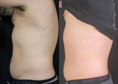 Man treated with Cryoskin - Man treated with Cryoskin
