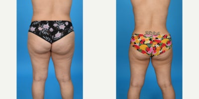 35-44 year old woman treated with Body Lift, Diastasis Recti Repair, Liposuction, Mommy Makeover, Panniculectomy, Tumescent Lipo - extended tummy tuck with Lipo 360, corset muscle plication, vaser high def lipo, etching.