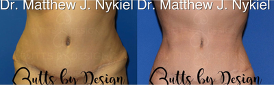 Woman treated with Liposuction Revision - Woman treated with Liposuction Revision