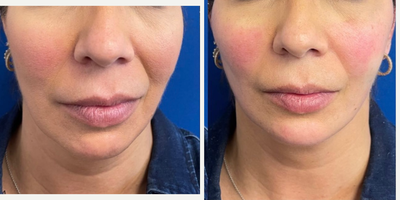 45-54 year old woman treated with Dermal Fillers, Neck Lift, Nonsurgical Facelift, Radiesse, Restylane, Thread Lift - PDO Miracu & Mint Lift Threadlift: Facial Contouring with Fillers: RHA, Radiesse and Restylane- 54 year old female with loss of facial fat causing an uneven face with a loss of cheek & jawline contour. Using a combination of PDO Threads: Miracu & Mint Threads and facial fillers the cheek was and Jawline was enhanced yielding a natural and rejuvenated appearance. Dr. Jeffrey Rosenthal is a Board Certified Plastic Surgeon and International Artist with offices in Connecticut and Long Island, N.Y.