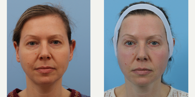 45-54 year old woman treated with Laser Treatment - Improved skin laxity after one Tempsure envi treatment
