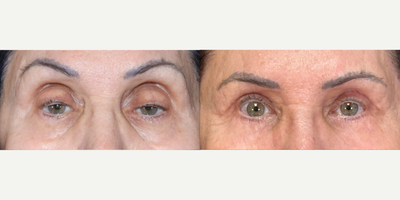 65-74 year old woman treated with Eyelid Surgery, Ptosis Surgery, Facial Fat Transfer - A stunning transformation for my beautiful patient! 