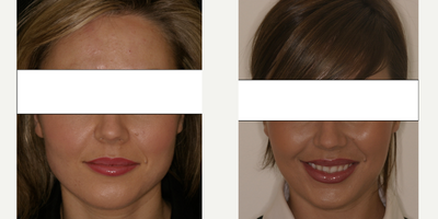 25-34 year old woman treated with Botox for Migraines - Lady presented with constant headaches, backache and neck ache. Patient had used a dental splint (soft) but not had any relief from this. We treated this condition with a combination of a specially made dental splint in conjunction with Botulinum toxin (botox) treatment in the lower and upper jaw muscles. As you can see from the before and after photographs the patient is not only relived of paid and headaches but also has a less built up jaw and now presents with a much slimmer face shape.