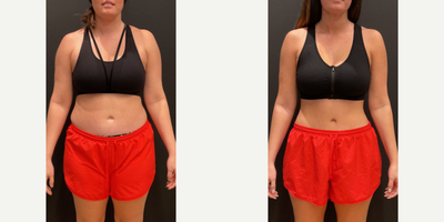 25-34 year old woman treated with Ozempic for Weight Loss - 40 LB weight loss in 6 months on our Skinny Shot
