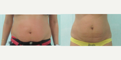 25-34 year old woman treated with Exilis - A 32-year-old female complains of saggy tummy post delivery. Exilis was done to tighten the tummy.