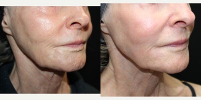 75 and up year old woman treated with UltraClear Laser, Restylane Silk, Restylane Refyne, Restylane Defyne, Dermal Fillers - 75 and up year old woman treated with UltraClear Laser, 3 syringes Restylane Silk, 3 syringes Restylane Refyne, 1 syringe of Restylane Defyne.