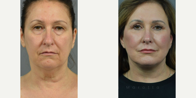 Woman treated with Laser Resurfacing - BlepharoplastyDeep Plane FaceliftFat GraftingLaser or Renuvion Skin ResurfacingSeptorhinoplasty