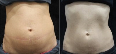 25-34 year old woman treated with SculpSure - Abdomen and Love Handles Treated