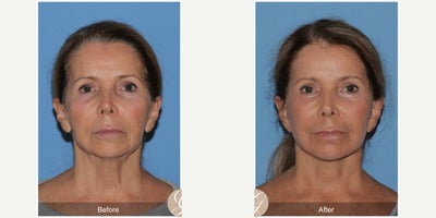 69 year old woman treated with Deep Plane Facelift, Facelift, Neck Lift, Dermal Fillers, MACS Facelift - 69 year old woman treated with Deep Plane Face and Neck Lift, Filler to the Temples and Chin, Laser to Face MAC
